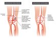 Genicular Artery Embolization