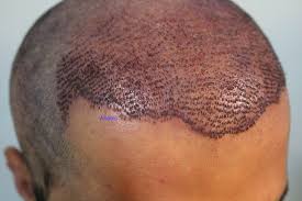 hair transplant in Lahore