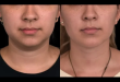 Double Chin removal