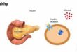 Pancreas Transplant vs. Insulin