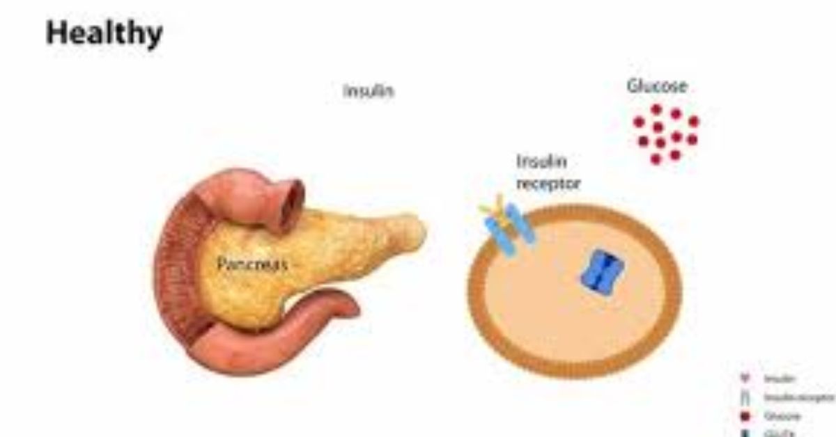 Pancreas Transplant vs. Insulin