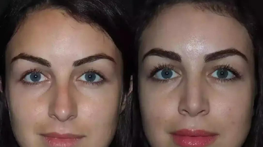 Understanding Nasal Anatomy and the Need for Septoplasty in Dubai